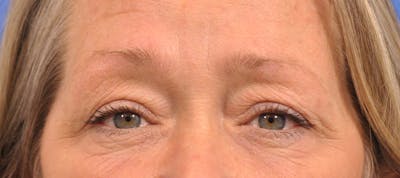 Blepharoplasty Before & After Gallery - Patient 329525 - Image 1