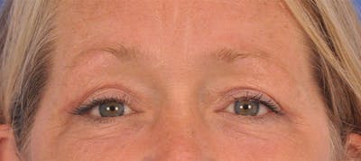 Blepharoplasty Before & After Gallery - Patient 329525 - Image 2