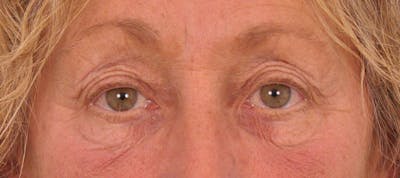Blepharoplasty Before & After Gallery - Patient 138510 - Image 1