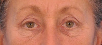 Blepharoplasty Before & After Gallery - Patient 138510 - Image 2