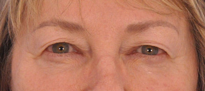 Blepharoplasty Before & After Gallery - Patient 632445 - Image 1