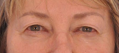 Blepharoplasty Before & After Gallery - Patient 632445 - Image 1
