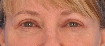 Blepharoplasty Before & After Gallery - Patient 632445 - Image 2