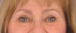 Blepharoplasty Before & After Gallery - Patient 384523 - Image 2