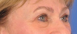 Blepharoplasty Before & After Gallery - Patient 384523 - Image 4