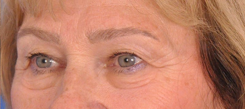 Blepharoplasty Before & After Gallery - Patient 384523 - Image 5