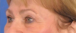Blepharoplasty Before & After Gallery - Patient 384523 - Image 6