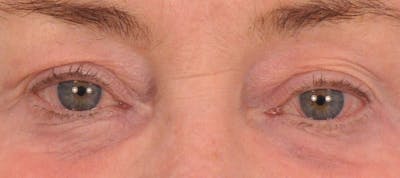 CO2RE Laser Before & After Gallery - Patient 352598 - Image 2