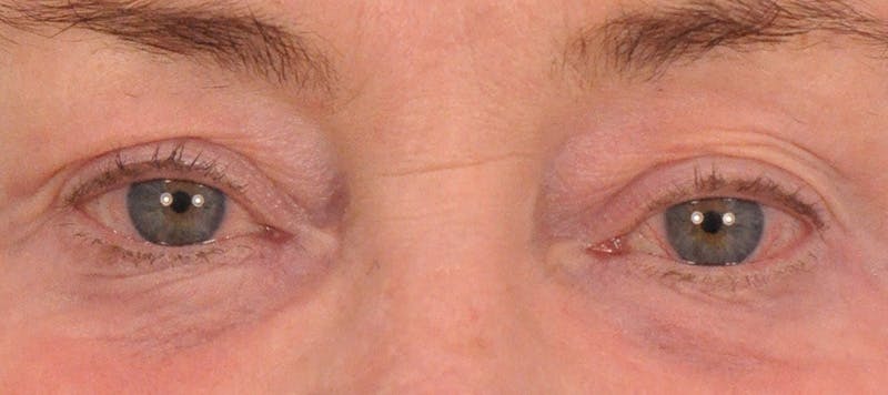 CO2RE Laser Before & After Gallery - Patient 352598 - Image 2