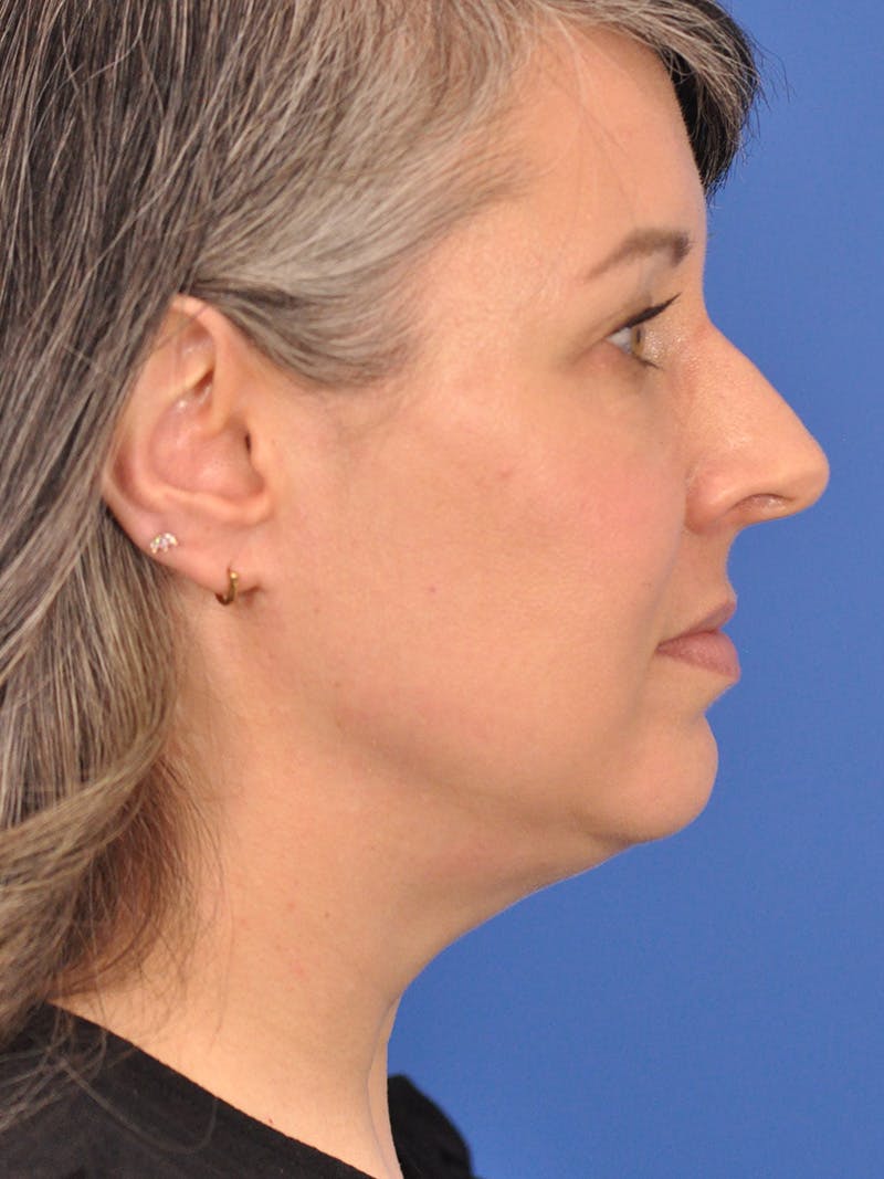 Neck Lift Before & After Gallery - Patient 380161 - Image 1