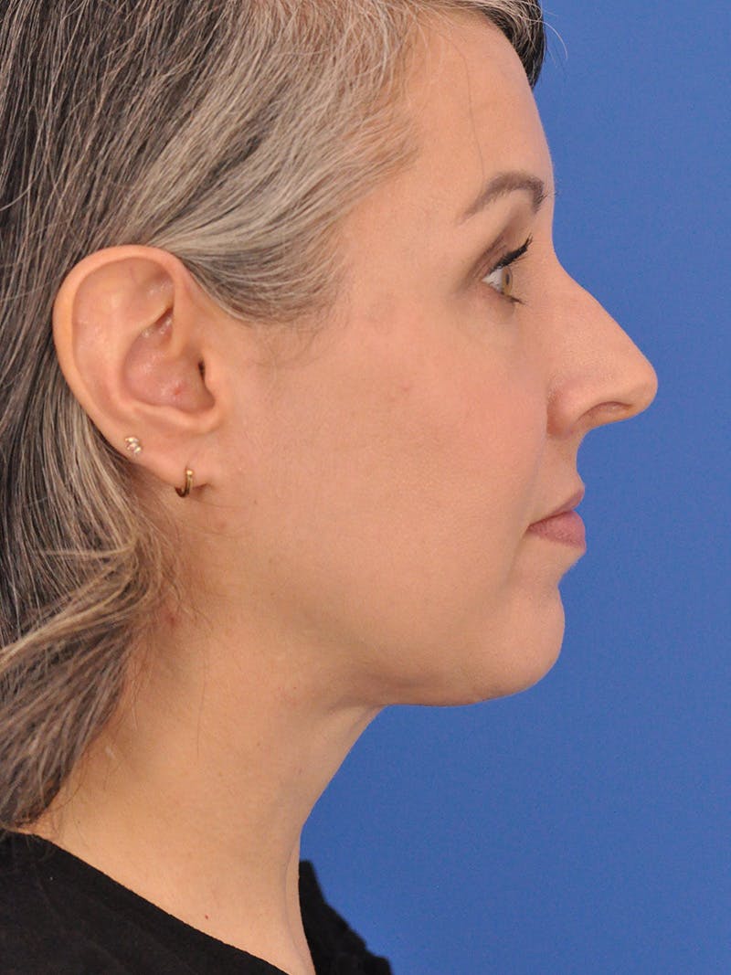 Neck Lift Before & After Gallery - Patient 380161 - Image 2