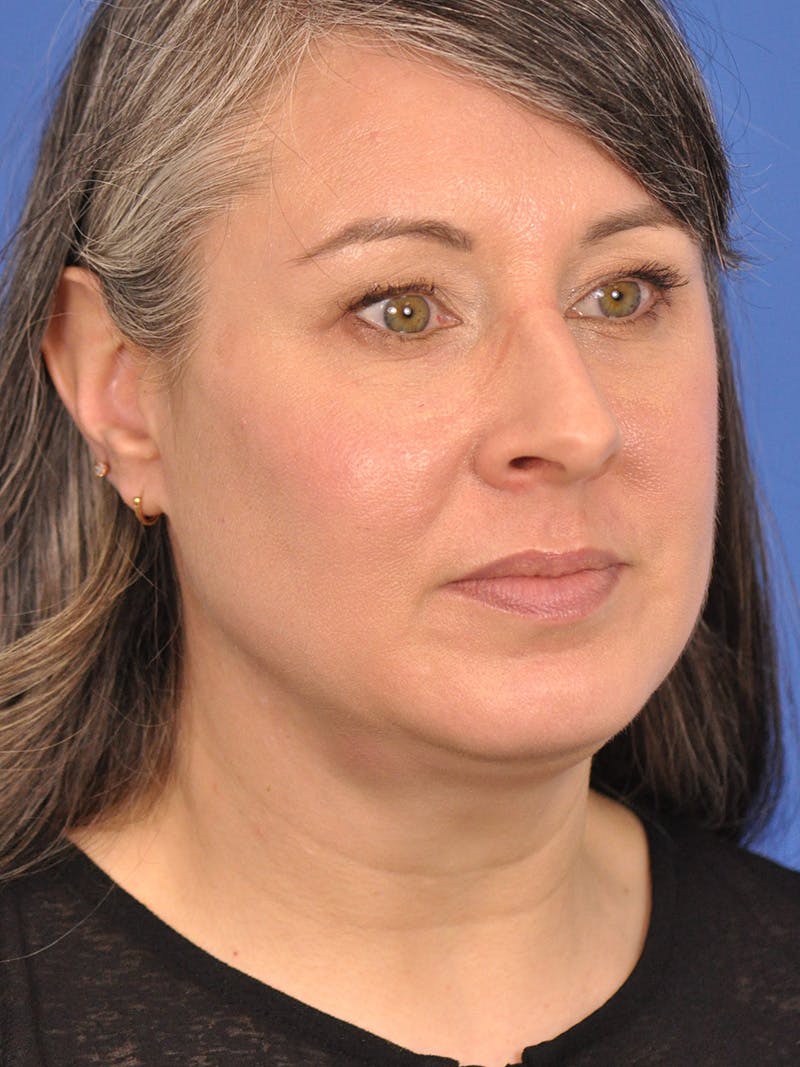 Neck Lift Before & After Gallery - Patient 380161 - Image 3