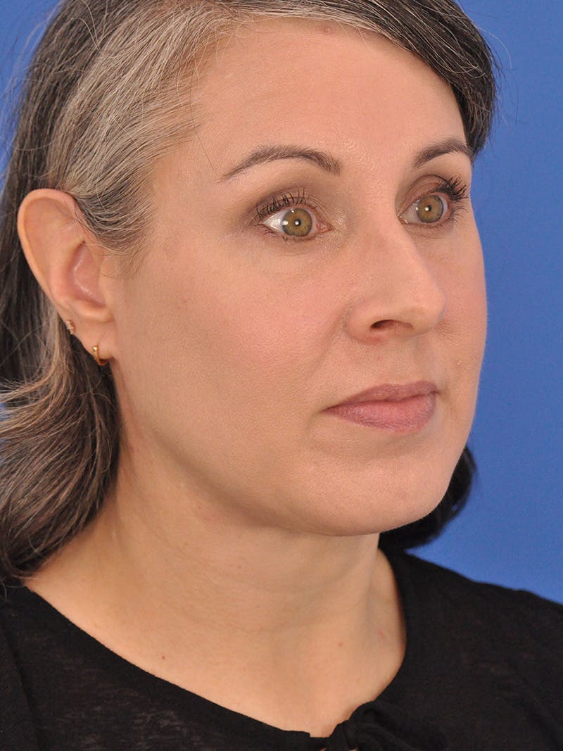 Neck Lift Before & After Gallery - Patient 380161 - Image 4