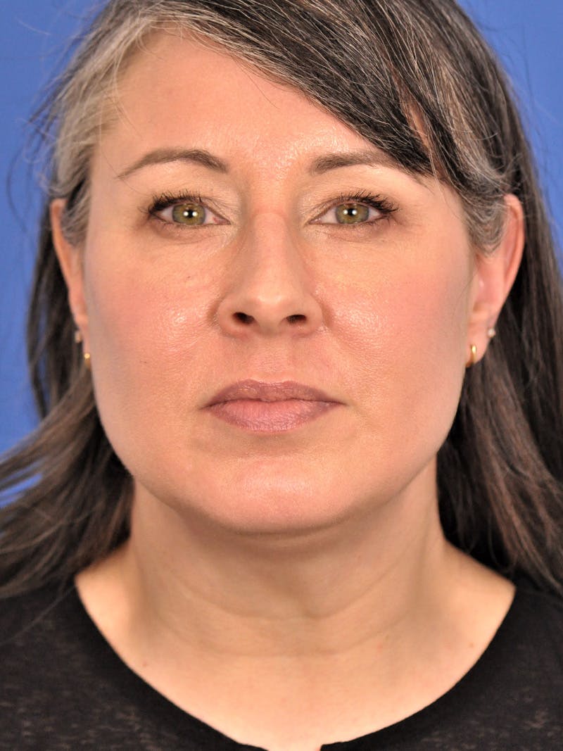 Neck Lift Before & After Gallery - Patient 380161 - Image 5