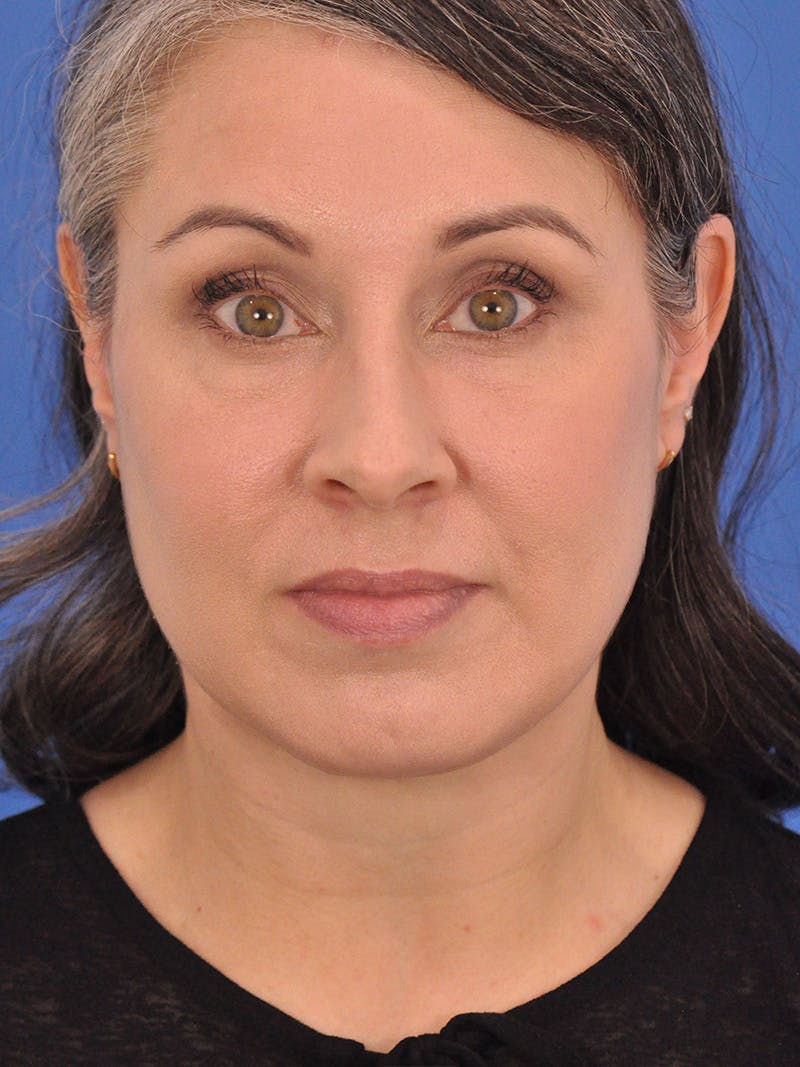 Neck Lift Before & After Gallery - Patient 380161 - Image 6