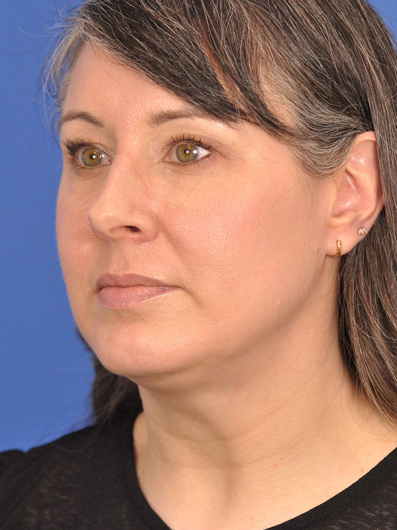 Neck Lift Before & After Gallery - Patient 380161 - Image 7
