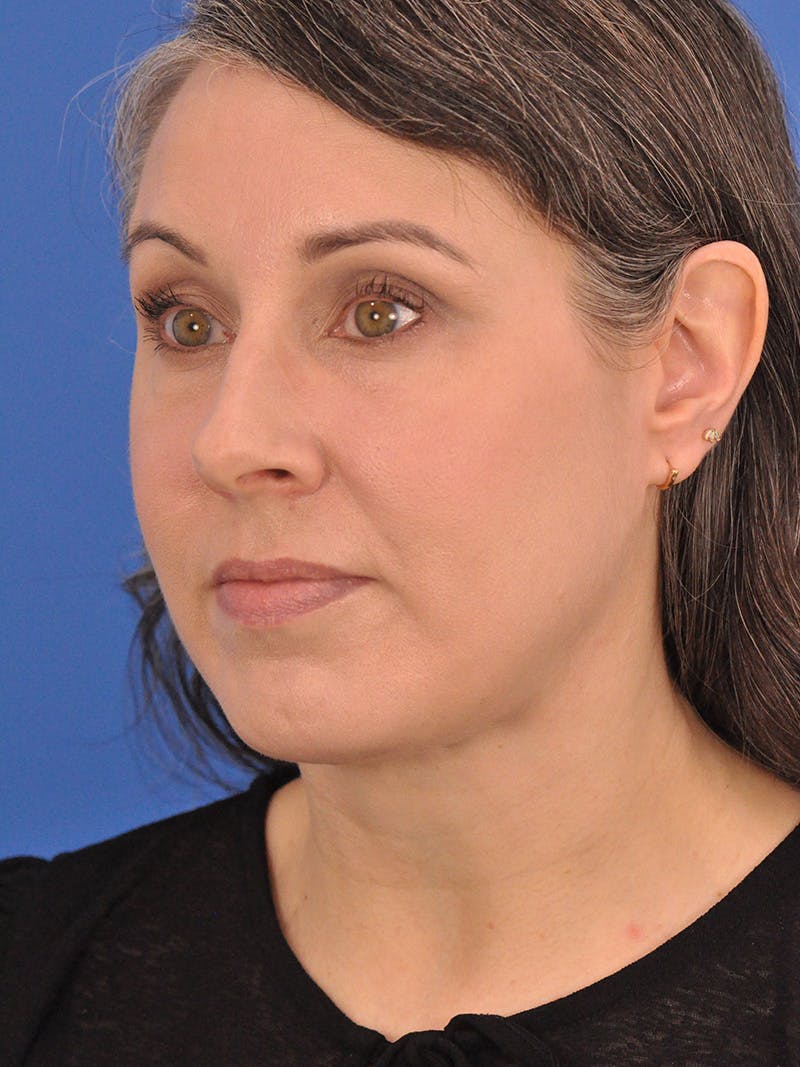 Neck Lift Before & After Gallery - Patient 380161 - Image 8