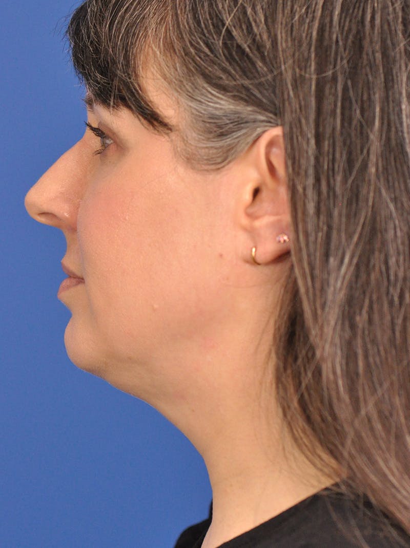 Neck Lift Before & After Gallery - Patient 380161 - Image 9