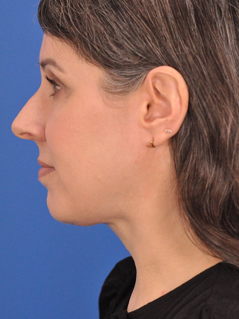 Neck Lift Before & After Gallery - Patient 380161 - Image 10