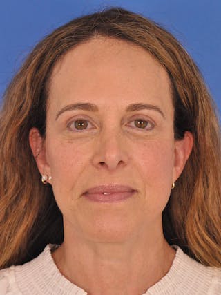 Facelift Before & After Gallery - Patient 334342 - Image 2