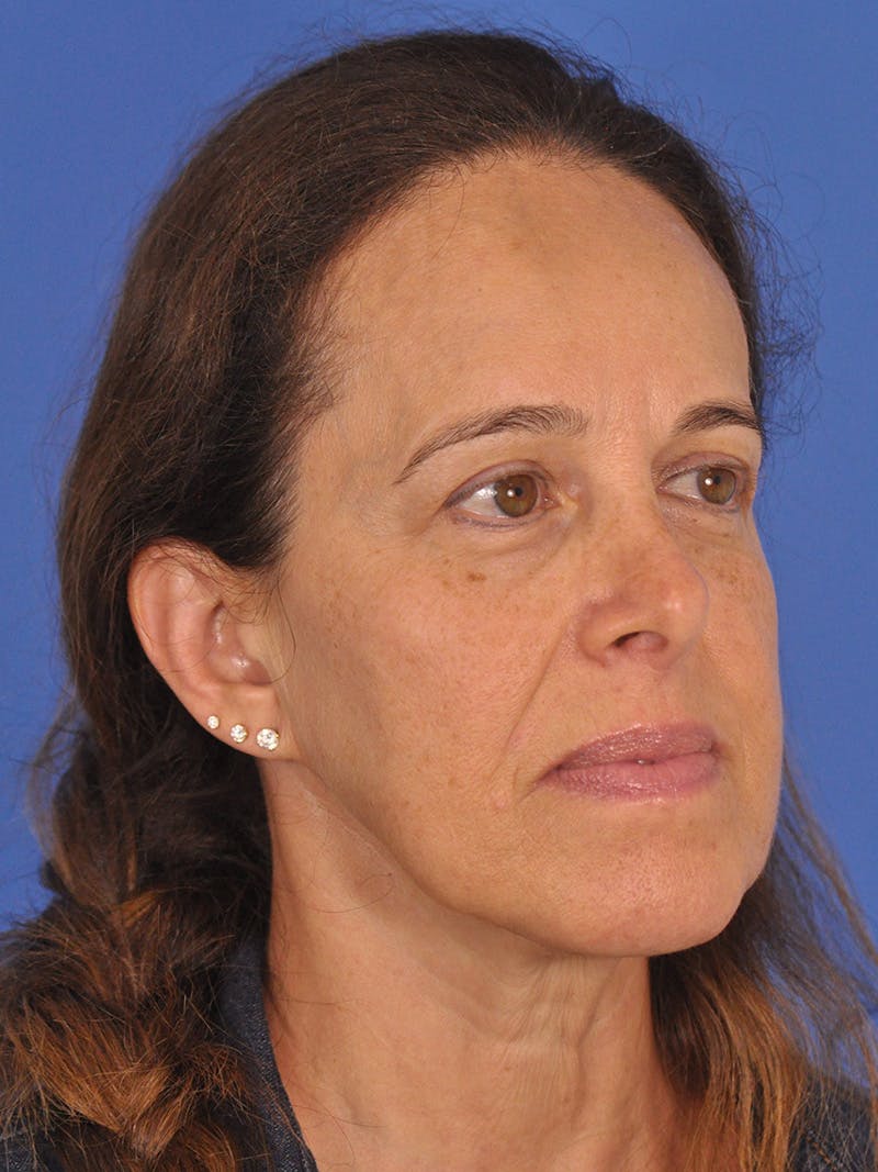 Facelift Before & After Gallery - Patient 334342 - Image 3