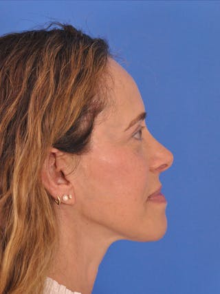 Facelift Before & After Gallery - Patient 334342 - Image 6