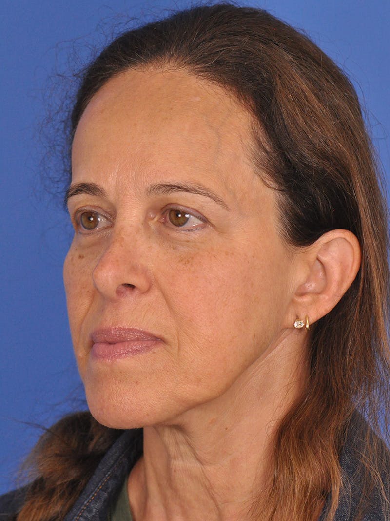 Facelift Before & After Gallery - Patient 334342 - Image 7