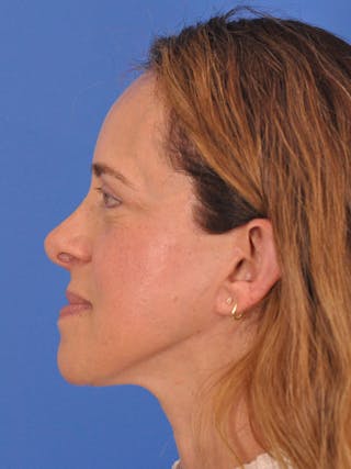 Facelift Before & After Gallery - Patient 334342 - Image 10