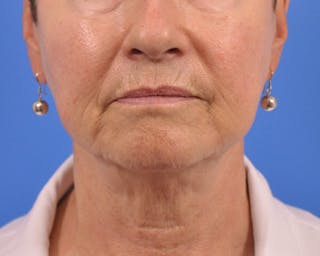 CO2RE Laser Before & After Gallery - Patient 164733 - Image 2