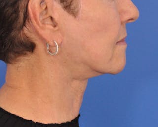 CO2RE Laser Before & After Gallery - Patient 164733 - Image 4