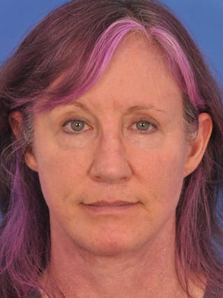 Facelift Before & After Gallery - Patient 102255 - Image 2