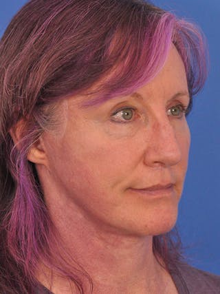Facelift Before & After Gallery - Patient 102255 - Image 4