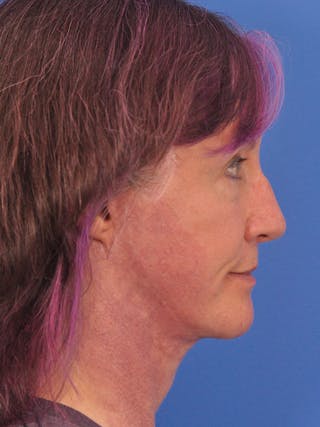 Facelift Before & After Gallery - Patient 102255 - Image 6
