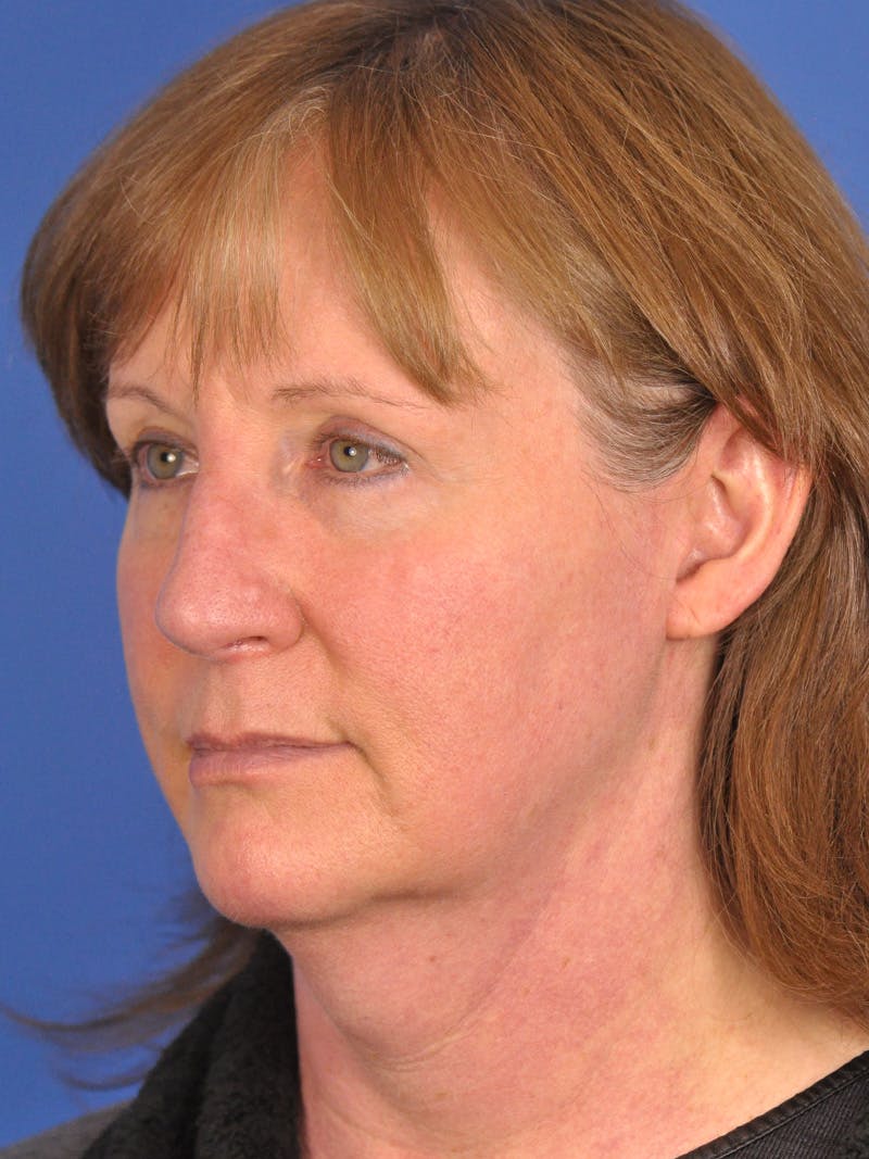 Facelift Before & After Gallery - Patient 102255 - Image 7