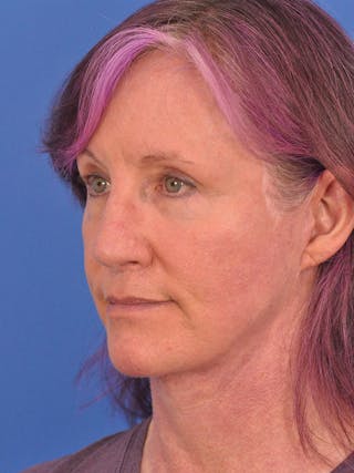 Facelift Before & After Gallery - Patient 102255 - Image 8