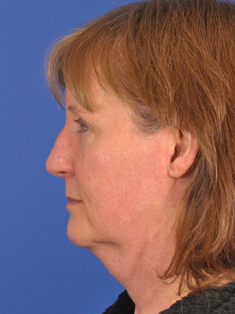 Facelift Before & After Gallery - Patient 102255 - Image 9