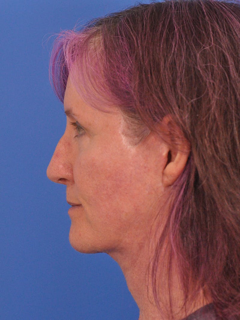 Facelift Before & After Gallery - Patient 102255 - Image 10