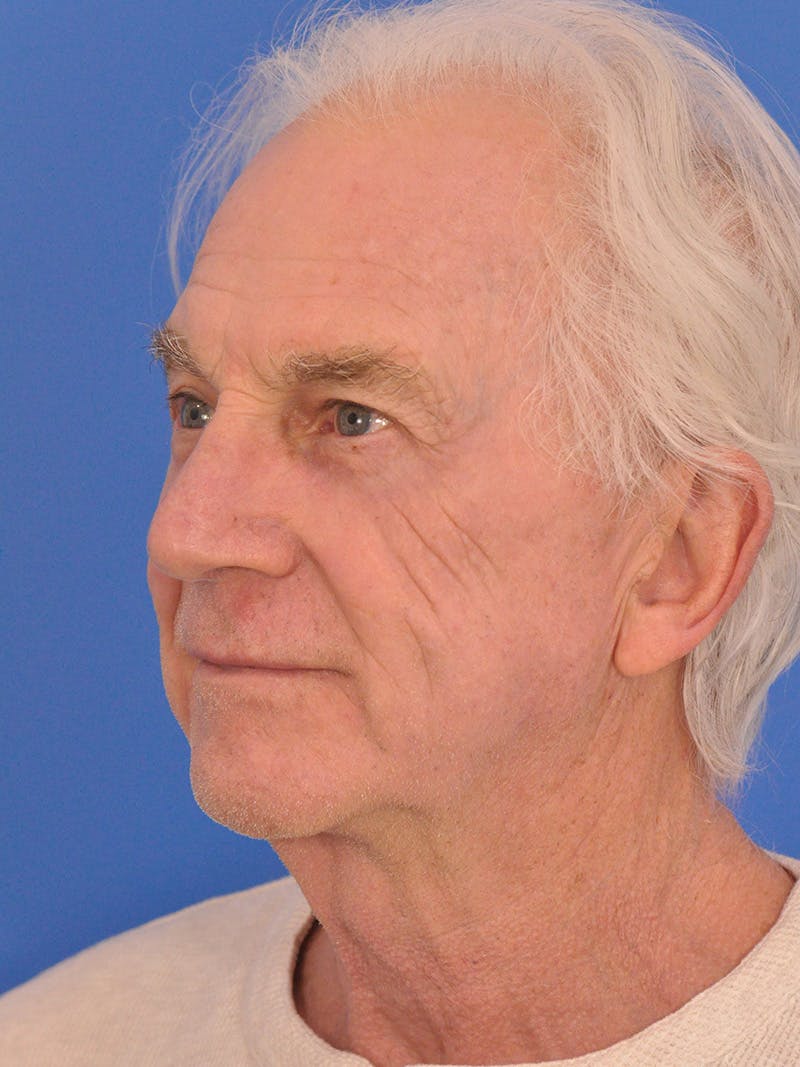 CO2RE Laser Before & After Gallery - Patient 368672 - Image 8