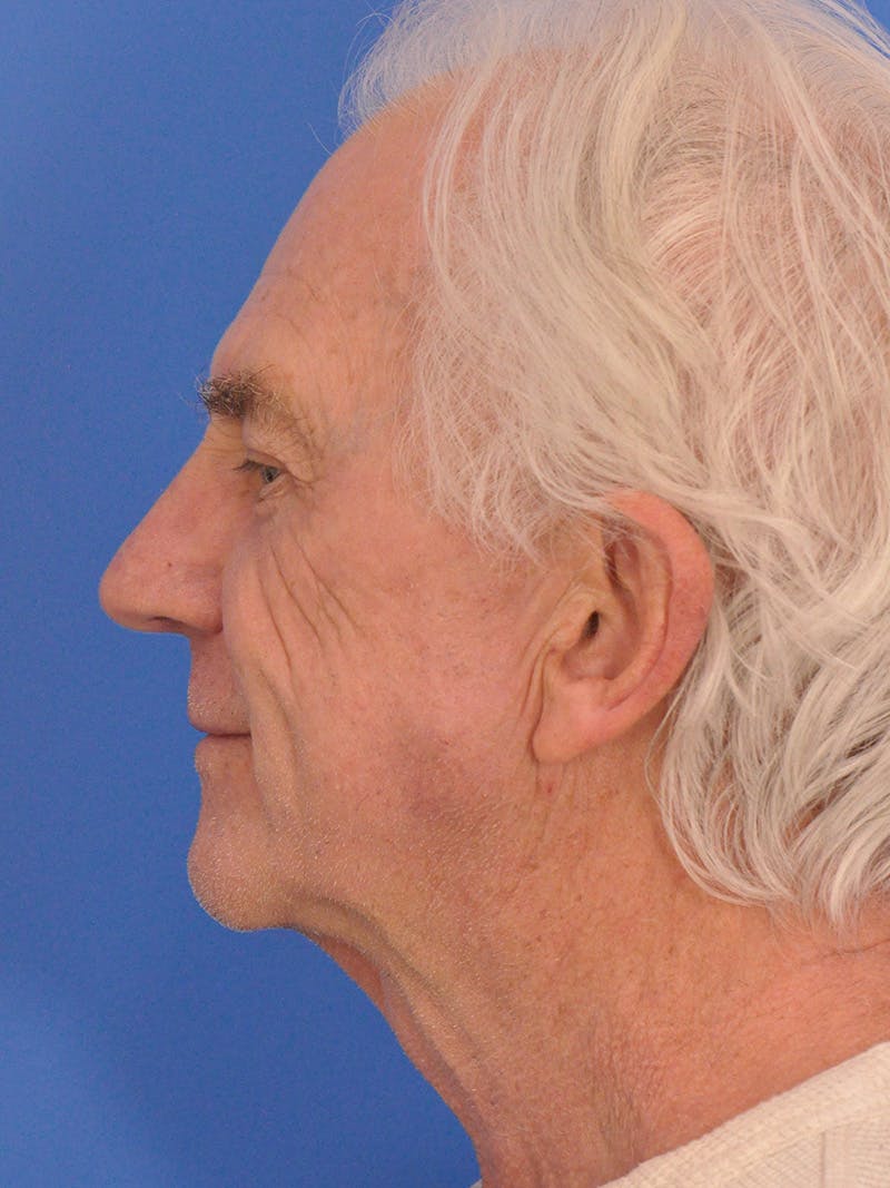 CO2RE Laser Before & After Gallery - Patient 368672 - Image 10
