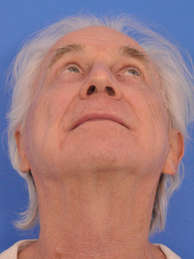 CO2RE Laser Before & After Gallery - Patient 368672 - Image 12