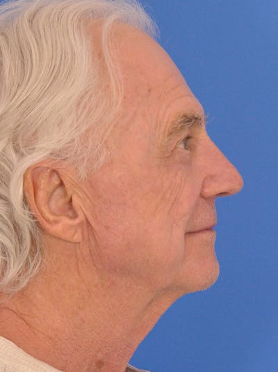 Rhinoplasty Before & After Gallery - Patient 937635 - Image 2