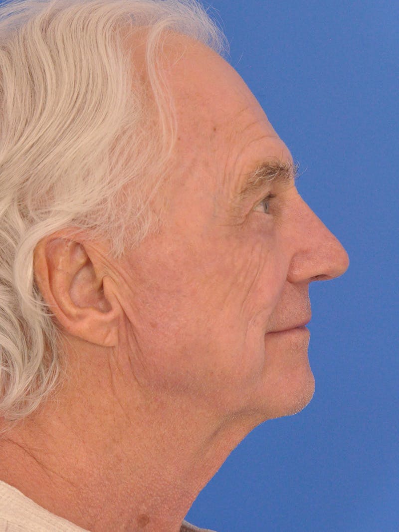 CO2RE Laser Before & After Gallery - Patient 368672 - Image 6