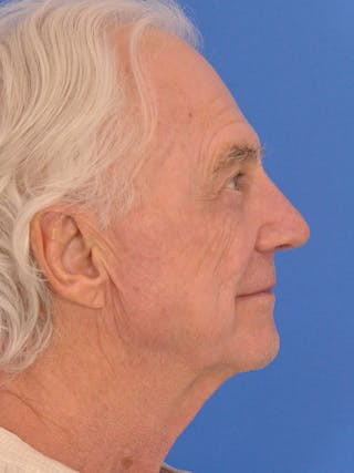 Rhinoplasty Before & After Gallery - Patient 937635 - Image 2