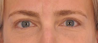 Blepharoplasty Before & After Gallery - Patient 125100 - Image 2