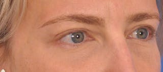 Blepharoplasty Before & After Gallery - Patient 125100 - Image 4