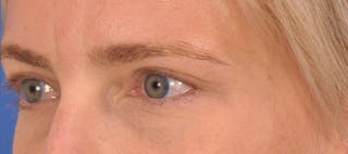 Blepharoplasty Before & After Gallery - Patient 125100 - Image 6