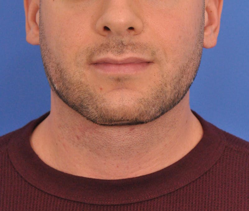 Neck Lift Before & After Gallery - Patient 334544 - Image 4