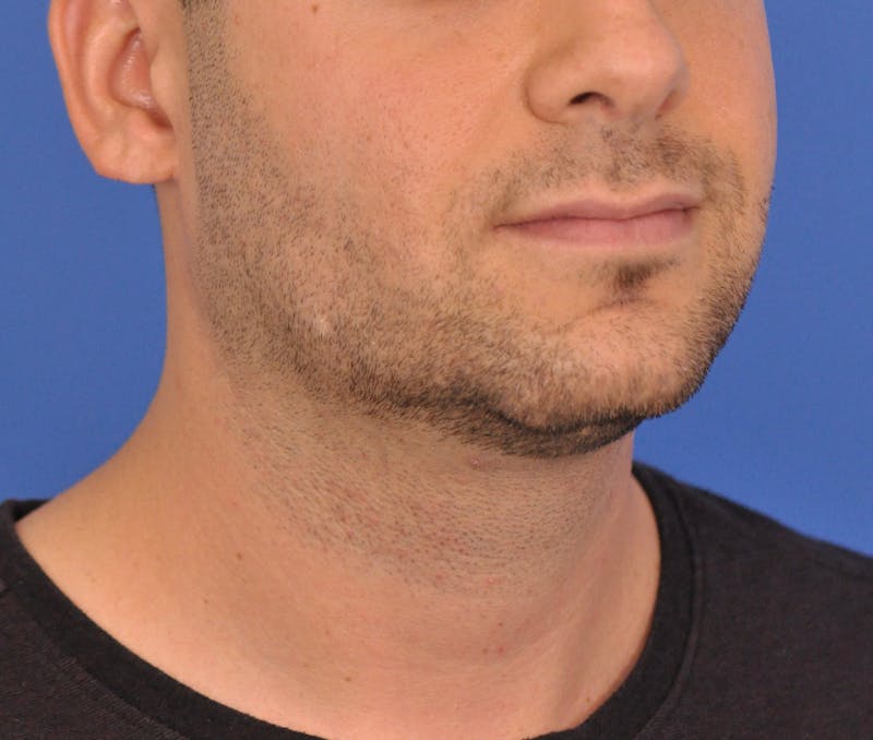 Neck Lift Before & After Gallery - Patient 334544 - Image 5