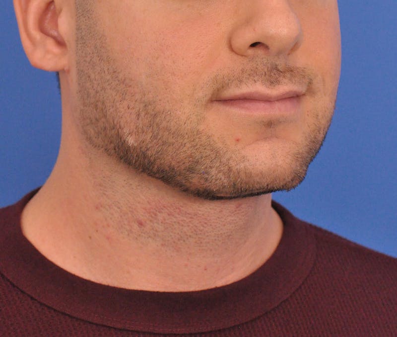 Neck Lift Before & After Gallery - Patient 334544 - Image 6