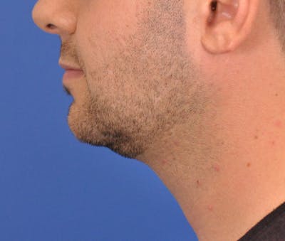 Neck Lift Before & After Gallery - Patient 334544 - Image 1
